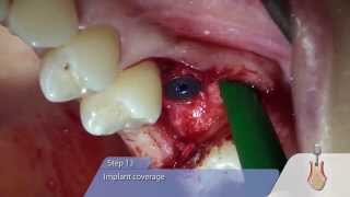 OT medical OTF3 ImplantInsertion with Sinus LiftOsteotomy [upl. by Airottiv]