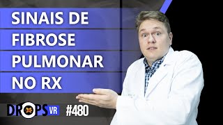 QUAIS OS SINAIS DE FIBROSE PULMONAR NO RX [upl. by Nawram]