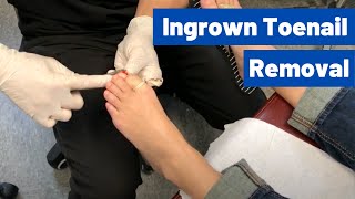 Ingrown Toenail Removal Surgery Video  Permanent Cosmetic Procedure [upl. by Concettina]