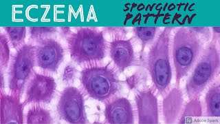 EczemaAtopic Contact Dermatitis etc Spongiotic Dermatitis Pattern  Inflammatory Dermpath Basics [upl. by Nahtnaoj]