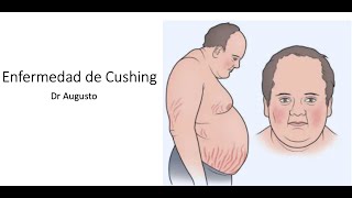 Hipercortisolismo Síndrome de Cushing y Enfermedad de Cushing [upl. by Comstock]