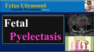 Fetus Ultrasound  Fetal Pyelectasis [upl. by Cecile]