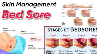 Skin management  Bed Sore amp types  Fundamental of Nursing  Tutor  Hanif khan [upl. by Aneehsirk]