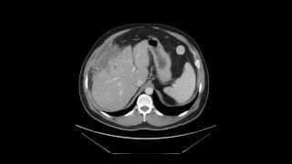 C difficil Pseudomembranous colitis  axial CT [upl. by Gudrin]