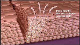 Cervical Cancer Disease Progression and Prevention Screen Manage and Diagnose More Accurately [upl. by Marcia]