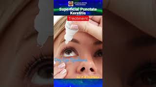 Superficial Punctate Keratitis Treatment [upl. by Akiemehs796]