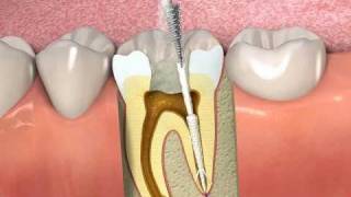 ProPoint How to obturate a root canal with SmartSeal [upl. by Lyret426]