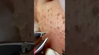 Skincare  Blackheads Removal 239 tweezers skincare blackheads blackheads [upl. by Henri530]