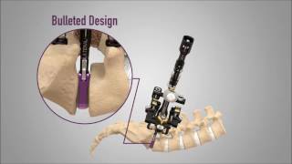 NuVasive® TLX™ Product Animation [upl. by Naic464]