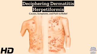 Dermatitis Herpetiformis Explained Symptoms Triggers and Relief [upl. by Aicele]