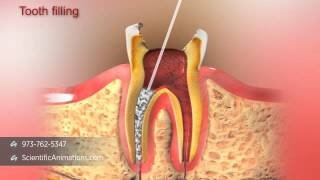 Root Canal Treatment [upl. by Chaffee604]