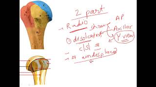 PROXIMAL HUMERUS FRACTURE [upl. by Thomasa]