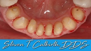 Veneer Preparation of Crowded Mandibular Teeth  Dental Minute with Steven T Cutbirth DDS [upl. by Edgerton]