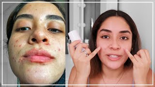 PRIMER MES CON TRATAMIENTO ANTI ACNÉ Con Epiduo Gel  Gabcamva [upl. by Nalyr]