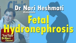 Fetal Hydronephrosis also known as pyelectasis or pelviectasis Discussed by Dr Nari Heshmati [upl. by Yllil]