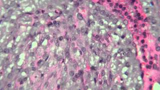 04 Phyllodes Tumor [upl. by Nivram]