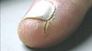 DermTV  How to Heal Cracked Fingertips DermTVcom Epi 125 [upl. by Hwang]