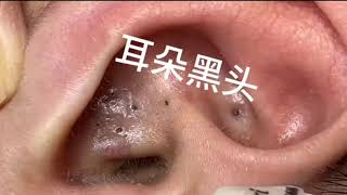 Treatment of Blackheads in The Ear for puberty men [upl. by Adran]