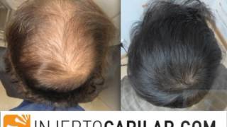 5652 FUs Hair Transplant by FUE Technique Diffuse alopecia Injertocapilarcom [upl. by Frasier]