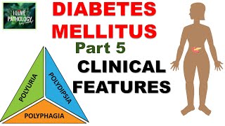 DIABETES MELLITUS  Part 5 Clinical Features  Classical triad [upl. by Kevyn]