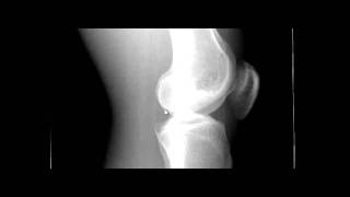 Lateral Knee Xray and Rotation [upl. by Eca]