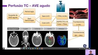 Aplicações práticas da perfusão por tomografia do encéfalo V2  GE do Brasil [upl. by Astrix715]