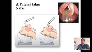 Anestesi Umum dan Anestesi Spinal [upl. by Aiykan]