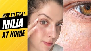 Milia treatment I How to treat Milia at Home  How to treat Milia under eyes  Milia removal cream [upl. by Ainnet]