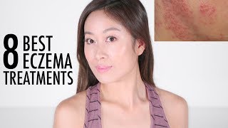 8 Best Eczema Treatments Recommended By Dermatologists  Vivienne Fung [upl. by Teddy23]