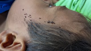 Remove lice from hair step by step  How to get out all hundred lice from his head [upl. by Ailemak892]