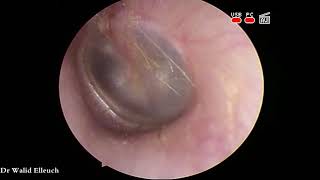 Moving middle ear fluids during Valsalva maneuvre  تحرك السوائل داخل الأذن الوسطى [upl. by Yeznil]