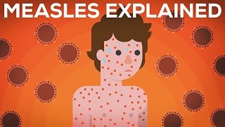 Measles Explained — Vaccinate or Not [upl. by Hess]