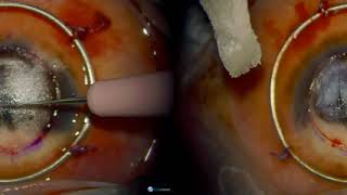 3D Surgery Deep Anterior Lamellar Keratoplasty DALK [upl. by Hermon348]