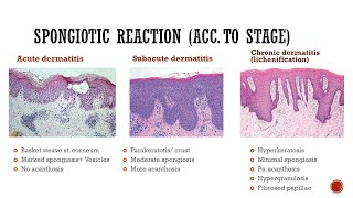 4 Spongiotic Dermatitis [upl. by Launamme201]