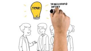 TCAR  TransCarotid Artery Revascularization Whiteboard Animation  Silk Road Medical [upl. by Marr697]