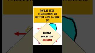 ROPLAS TEST dacryocystitis opthalmology [upl. by Mallin]