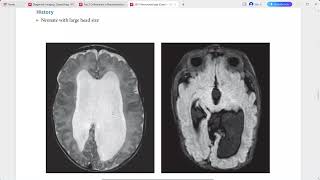 NEURORADIOLOGY EXAM CASES LECTURE [upl. by Sebbie]