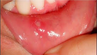 DermTV  The Difference Between Canker Sores and Herpes DermTVcom Epi 103 [upl. by Bathulda]