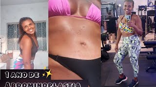 ABDOMINOPLASTIA PELO SUS  Resultado após 1 ano [upl. by Meeki361]