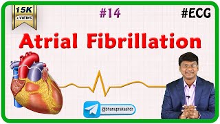 14 Atrial fibrillation  ECG assessment and ECG interpretation made easy [upl. by Elocal]