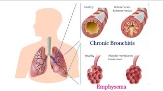 Chronic Bronchitis vs Emphysema  COPD  lungs 🫁 understanding the difference [upl. by Veronique455]