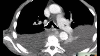 CT Mediastinum effusionsatelectasis Discussed by Radiologistmp4 [upl. by Shanna]