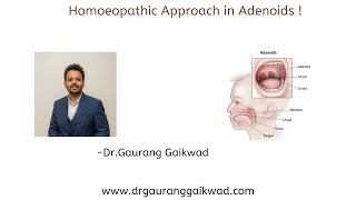 Homoeopathic Approach in Adenoids [upl. by Doolittle135]