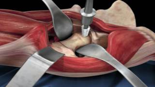 Direct Anterior Approach Hip Replacement [upl. by Yelnikcm]