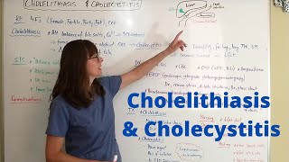 Cholelithiasis amp Cholecystitis [upl. by Anirtruc]