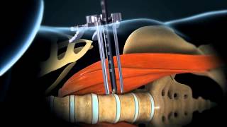 LLIF Lateral Lumbar Interbody Fusion  Larry Parker MD [upl. by Waly]