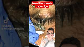 Crazy BLACKHEAD REMOVAL UNDER EYE  How Did This Happen shorts [upl. by Romeu]