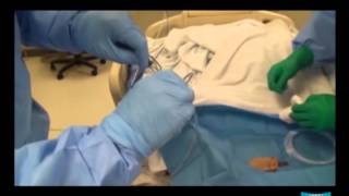 Percutaneous Endoscopic Gastrostomy pull method and Jejunal Extension Tube Placement [upl. by Zaccaria]