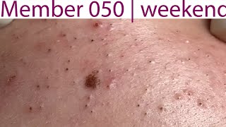 Acne Treatment Huong Da Nang 050  weekend  2023 [upl. by Silver]