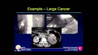 Imaging of Kidney Cancer Erik Mittra MD PhD Stanford University Radiology [upl. by Lias]